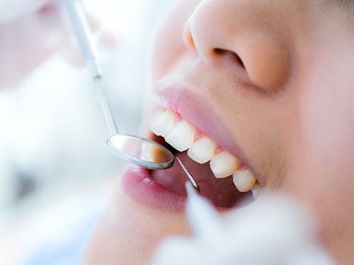 Composite Fillings