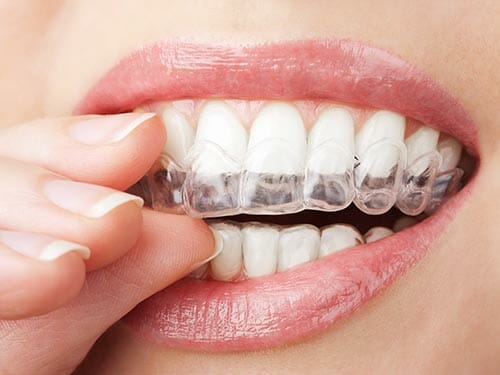 Certified Invisalign Provider in Colorado Springs